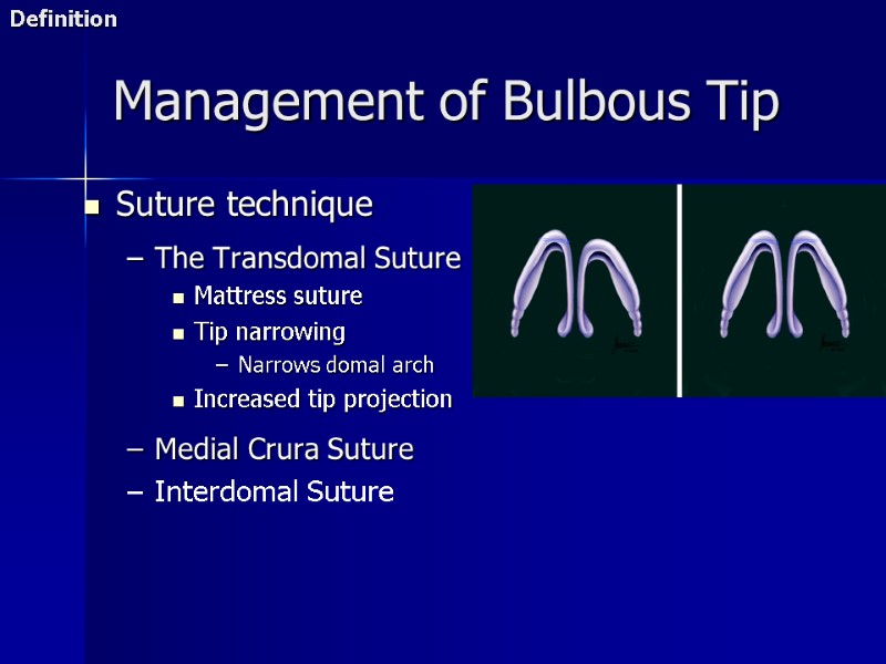 Management of Bulbous Tip Suture technique  The Transdomal Suture Mattress suture Tip narrowing
